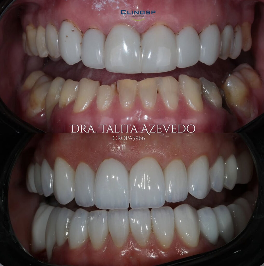 antes e depois facetas - lentes - dentista - clinosp prime