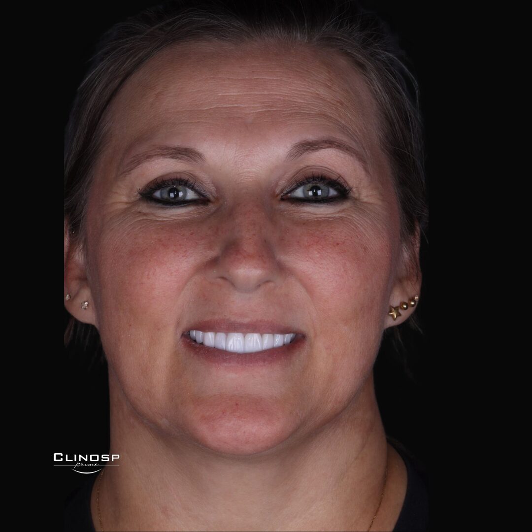 CLINOSP PRIME- FACETAS - DENTISTA - LENTES