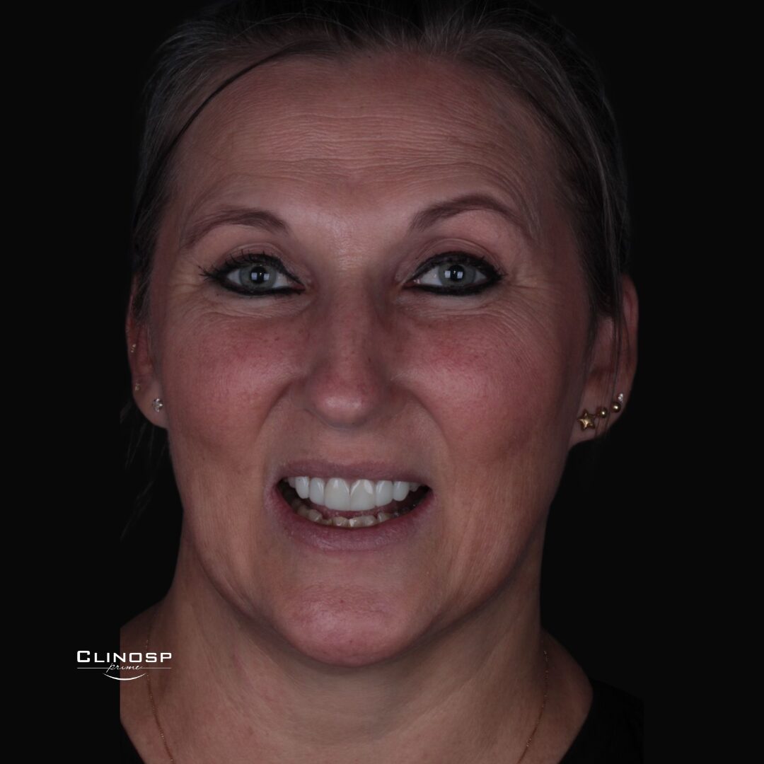 CLINOSP PRIME- FACETAS - DENTISTA - LENTES